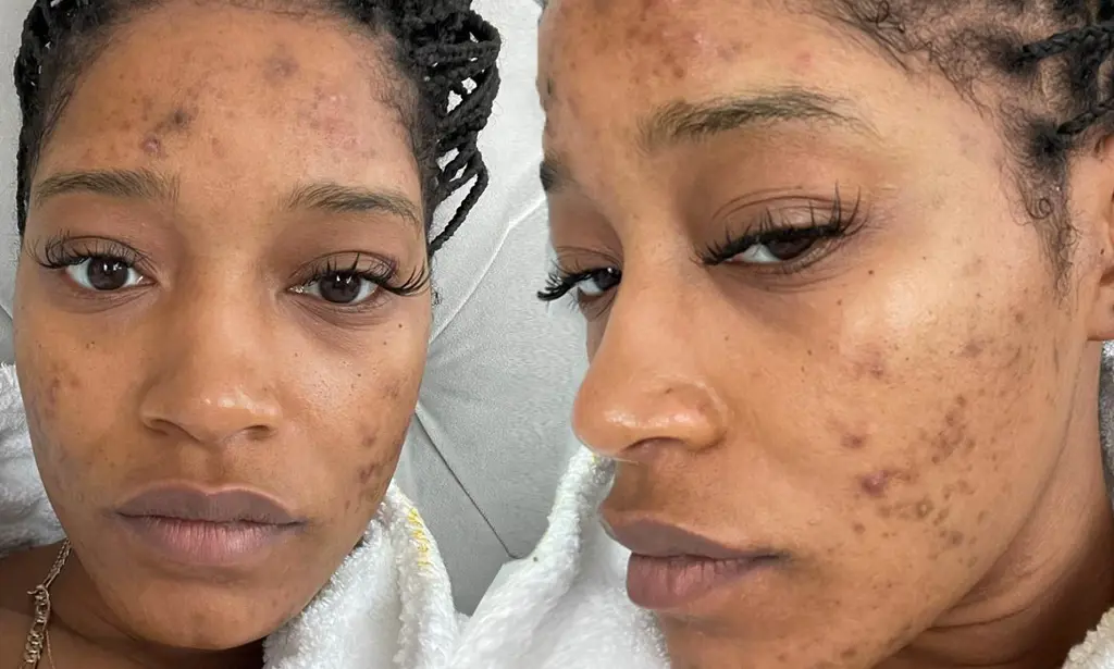 Keke Palmer suffers from PCOS