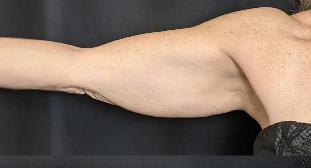 Karen Laine shared the photo of her arms while she was doing body sculpting methods for weight loss 